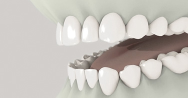 Bleaching Animation Dr. Kuebler Stuttgart