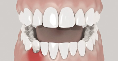 Parodontitisbehandlung Animation Dr. Kuebler Stuttgart