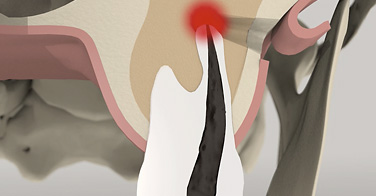 Wurzelspitzenresektion Animation Dr. Kuebler Stuttgart