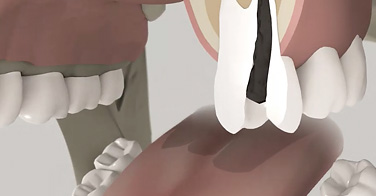 Wurzelspitzenresektion Animation Dr. Kuebler Stuttgart